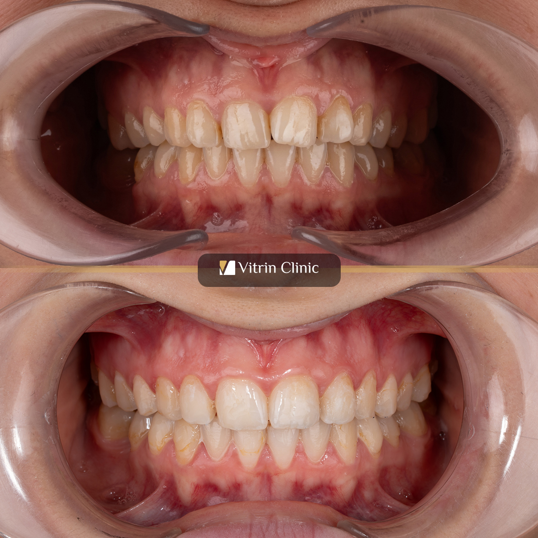 Invisalign